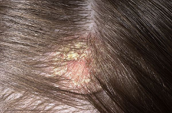 Себорея кожи головы: фото, симптомы, лечение сухой и жирной ...