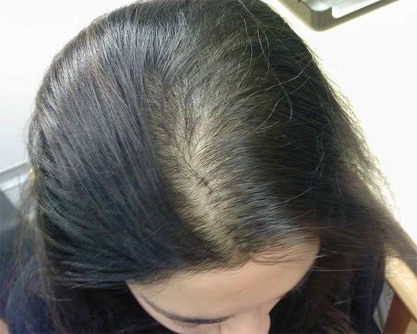 Анагеновое выпадение волос
