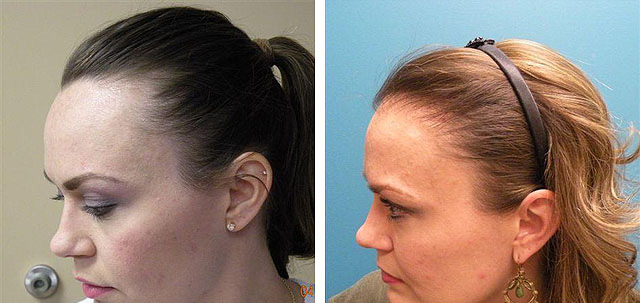 Фото: результат пересадки волос у женщины
