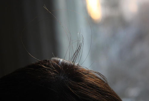 «Мивал» способствует сокращению потери волос и росту новых